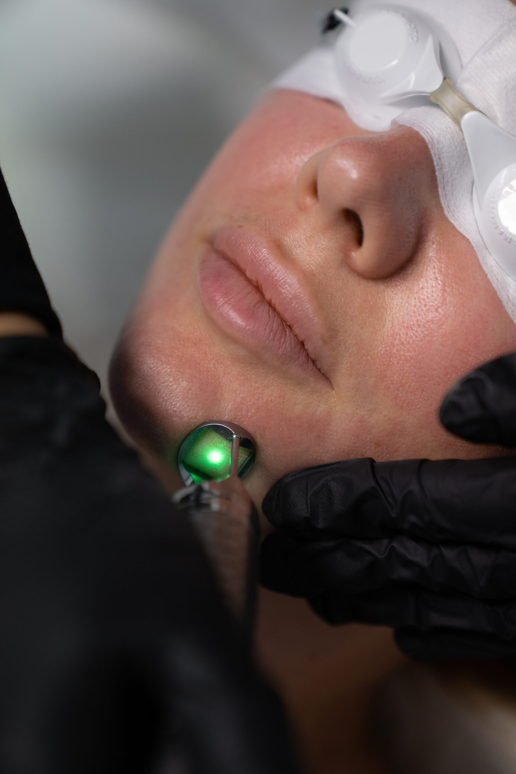 Fotona 4D Treatment at Skin Atelier Kilchberg