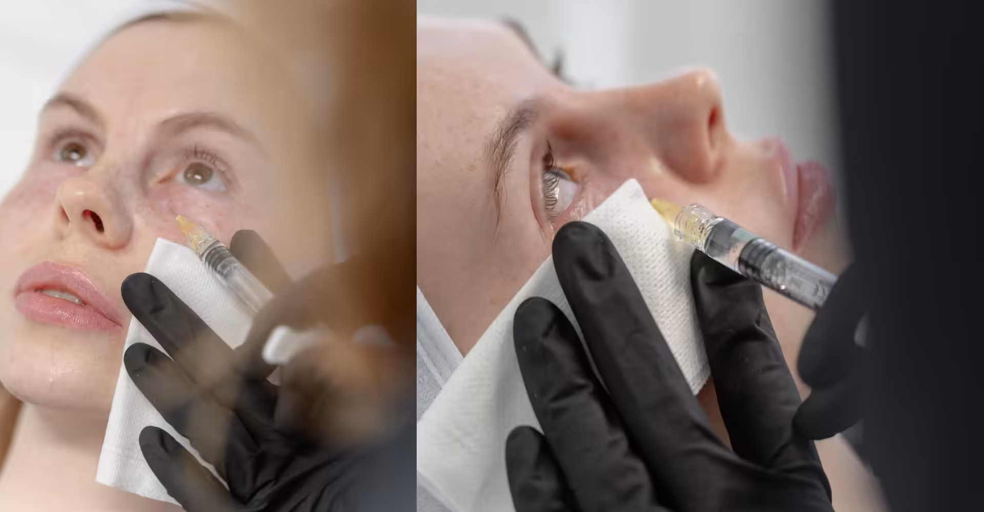Polynukleotid-Behandlung im Skin Atelier Kilchberg