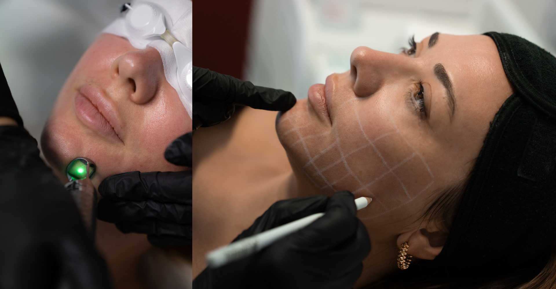 Rejuvenating the Face at Skin Atelier Kilchberg Zurich Fot ona 4D + Mesotherapy