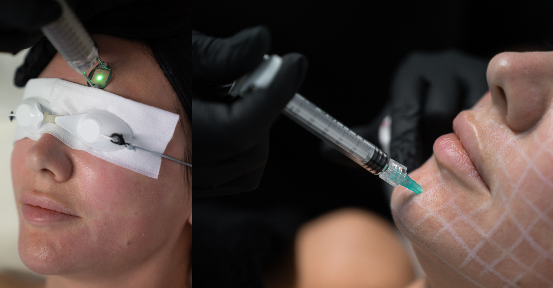Skin Atelier Kilchberg Signature Fotona 4D™ + Mesotherapy Protocol Zurich
